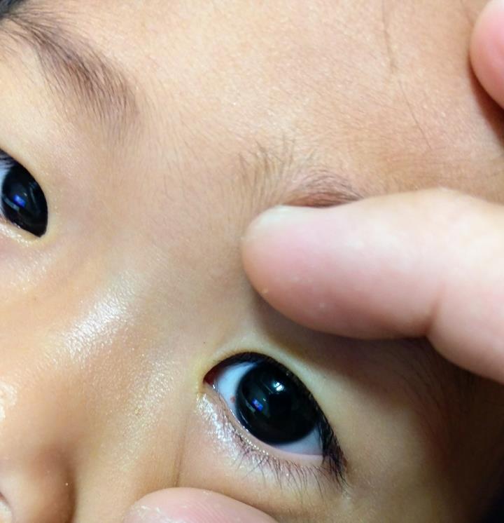 寶寶 小孩眼睛內長一顆痣 Mo Ptt 鄉公所