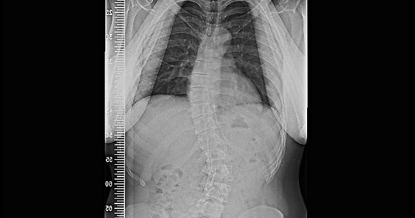 問題 改善脊椎側彎的訓練方式 Mo Ptt 鄉公所