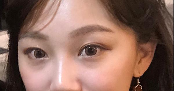 心得 分享我超滿意的眼袋手術 內開 補蘋果肌 Mo Ptt 鄉公所